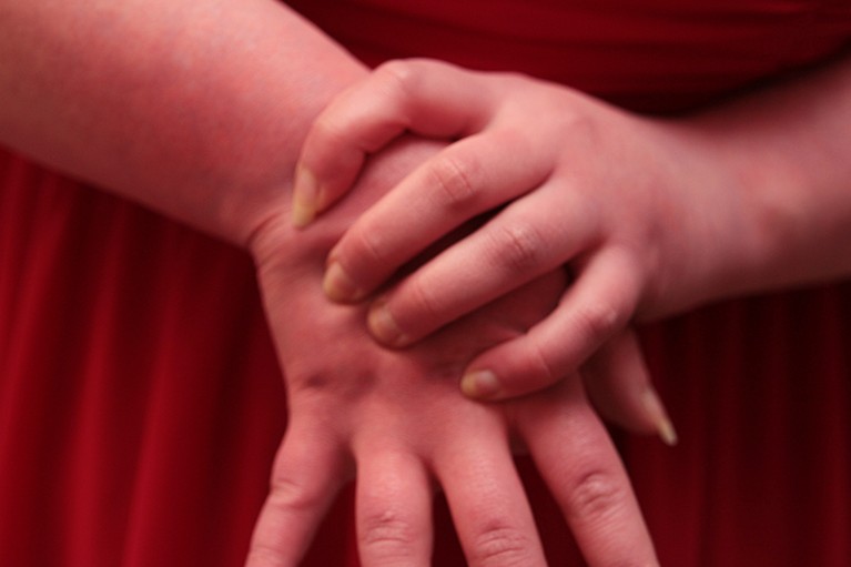 Close-up photograph of hands showing symptoms of erythromelalgia: they are red and inflamed.