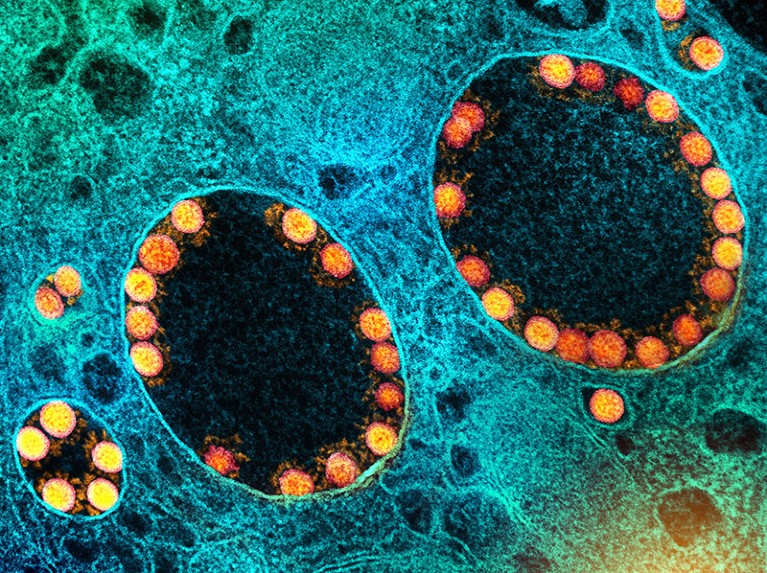 Coloured transmission electron micrograph of SARS-CoV-2 virus particles (gold) within endosomes of infected olfactory epithelial cells.