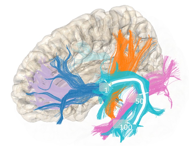 Image of brain tissue (white) with areas of purple, blue, orange, turquoise
