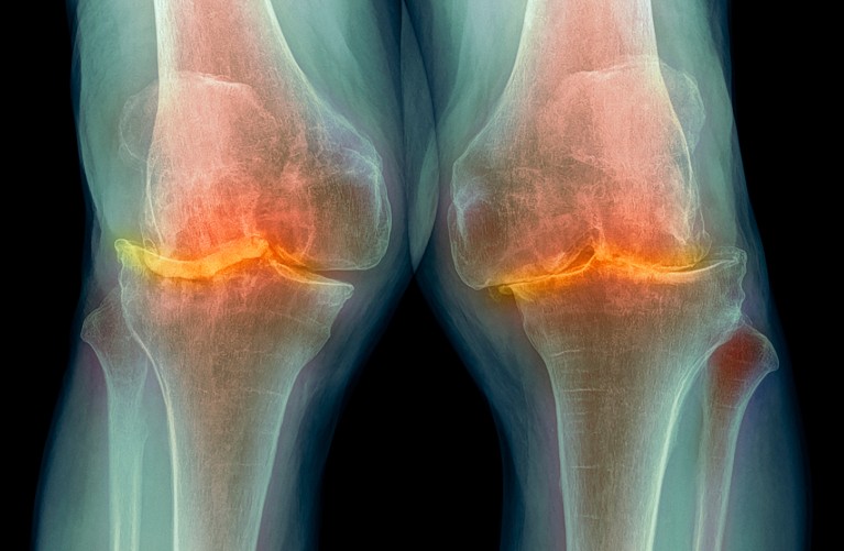 Colored x-ray of the knees of a patient with severe osteoarthritis, shown in blue and orange