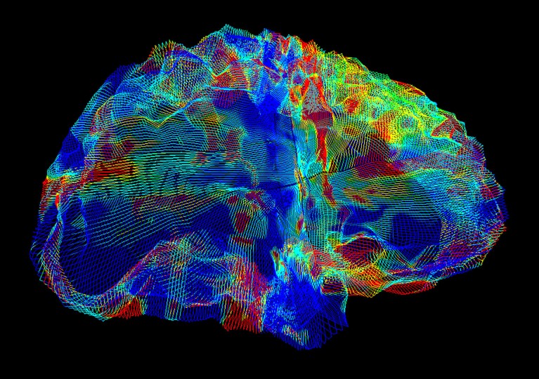 Coloured DTI MRI scan showing white matter fibres in the brain of a patient with Alzheimer's disease.