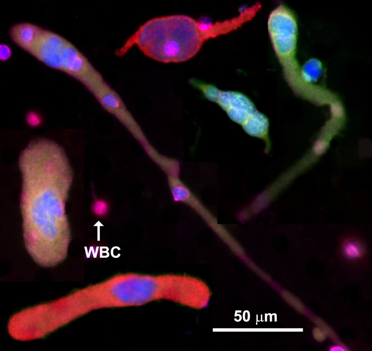 Cancer-associated macrophage-like cells (CAMLs) shown using fluorescent stains