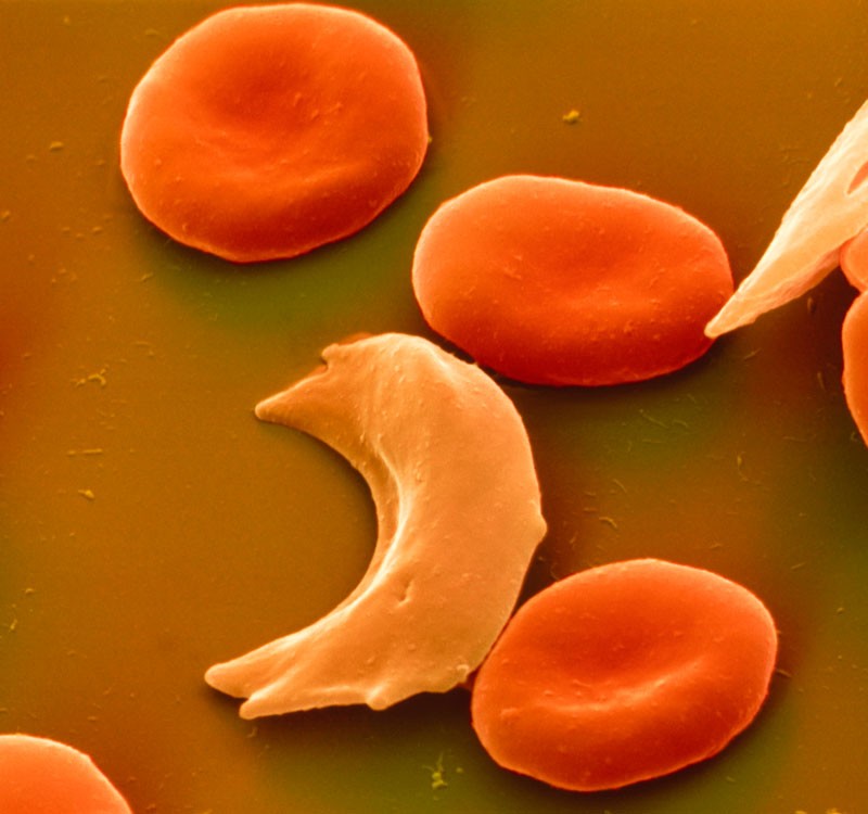 Sickle cell anaemia.