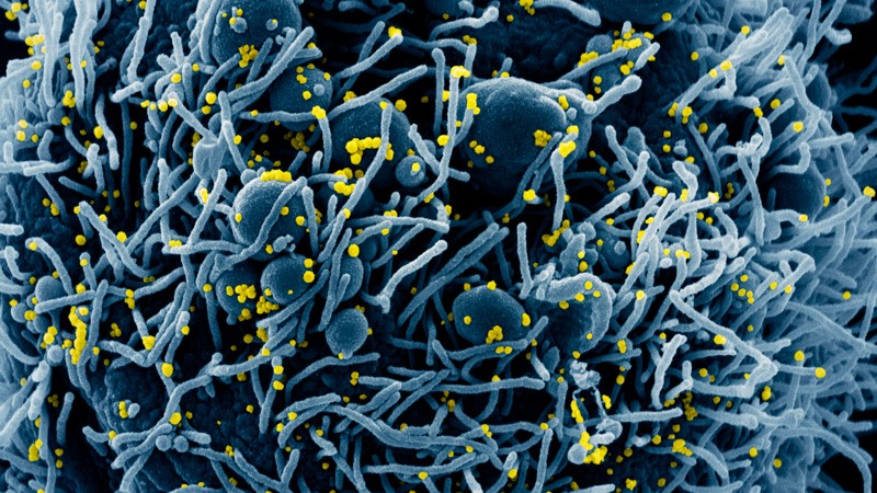 Cell infected with Covid-19 coronavirus particles, SEM.