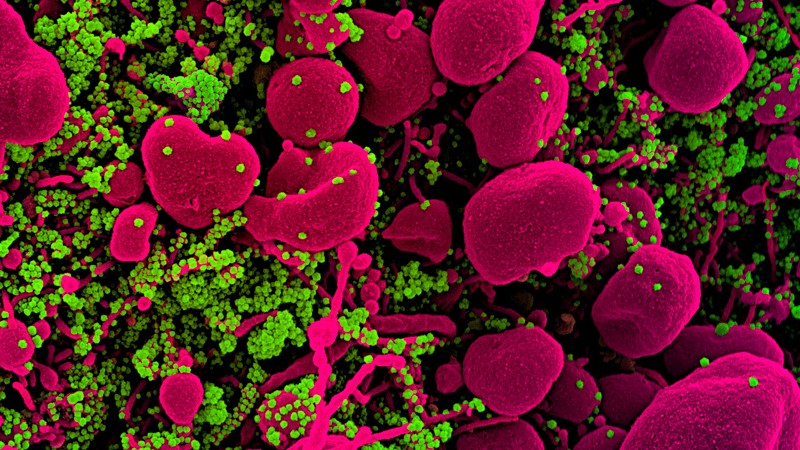 Coloured scanning electron micrograph (SEM) of SARS-CoV-2 coronavirus particles (green) on an apoptotic cell.