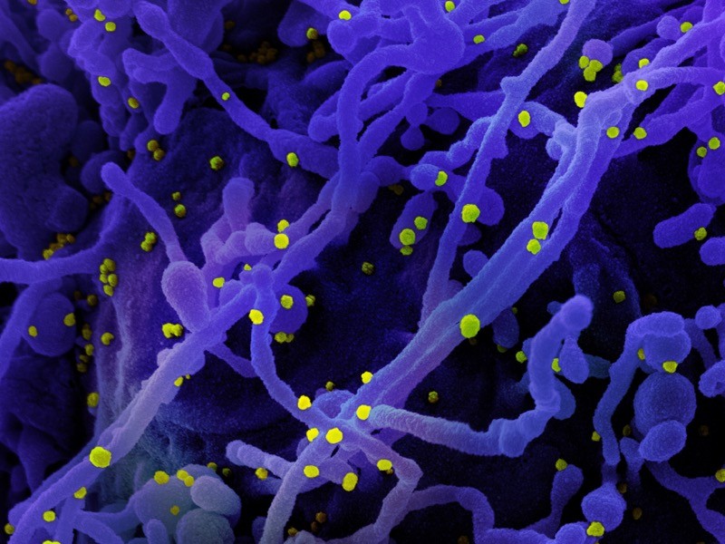 Colorized SEM of a cell (purple) infected with SARS-CoV-2 virus particles (yellow), isolated from a patient sample.