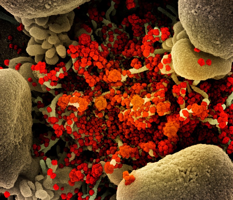 Coloured scanning electron micrograph of SARS-CoV-2