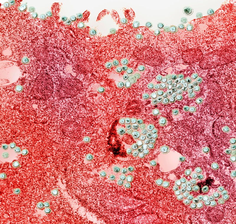 Coloured transmission electron micrograph of human coronavirus particles