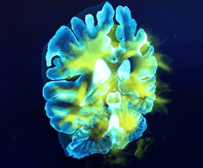3D brain reconstruction from an MRI scan