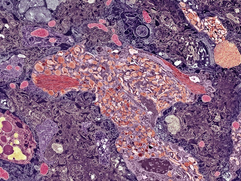 Amyloid plaque, TEM.