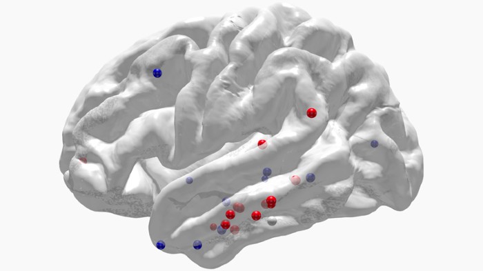 Stimulation of a brain region called the lateral temporal cortex (cluster of red pins) can improve memory.