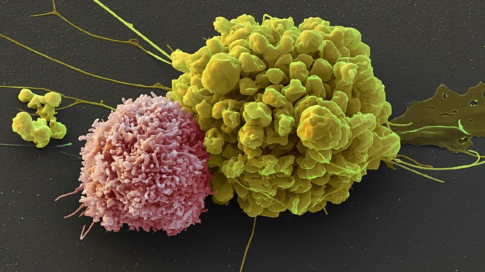 Scanning electron micrograph of an ependymoma cell and a natural killer cell