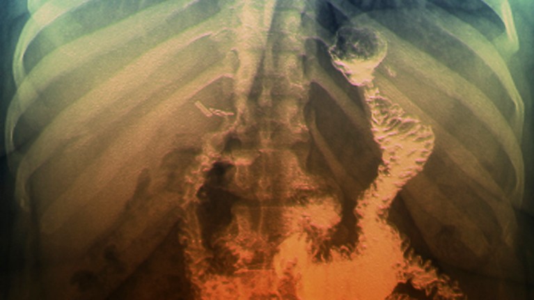 An X-ray shows the shrunken gastrointestinal tract resulting from a gastric bypass, which can help obese people to lose weight.
