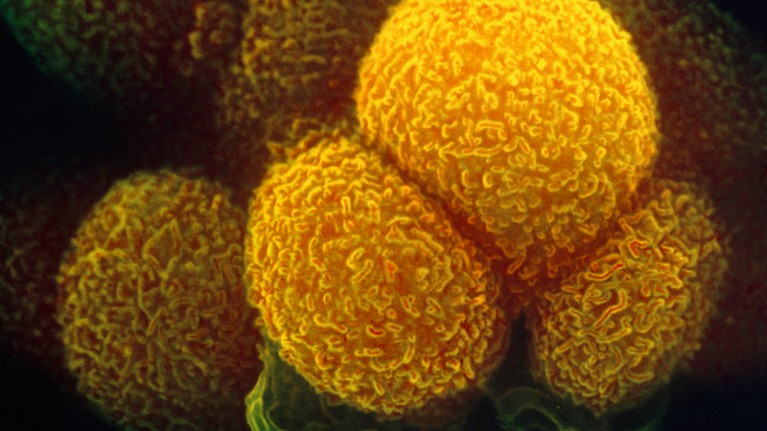 Coloured scanning electron micrograph of solon cancer cells