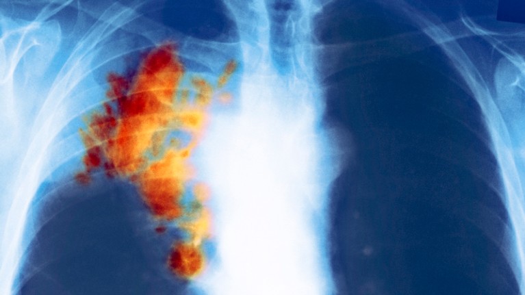 Coloured X-ray of the chest of a patient with small cell lung cancer
