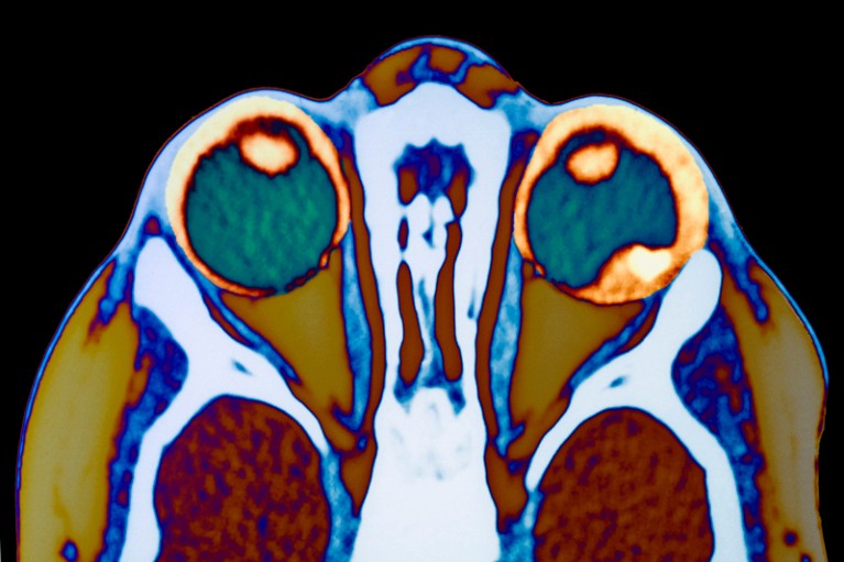 MRI scan of a patient's head showing a retinoblastoma tumour