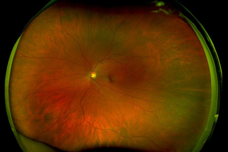 Colour scanning laser ophthalmoscope image of a healthy adult retina