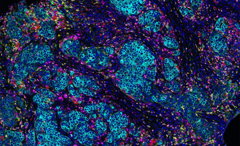 Breast cancer cells imaged with the Vectra Polaris multispectral slide imaging system