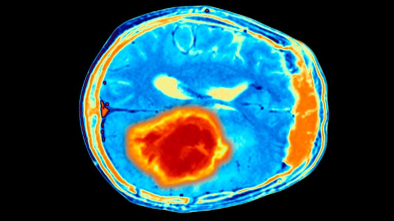 Coloured magnetic resonance imaging scan of brain with tumour.