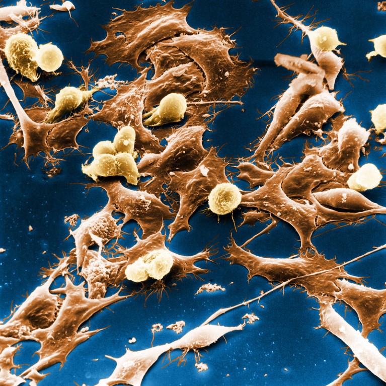 Colour enhanced scanning electron micrograph of Wilms' tumour.