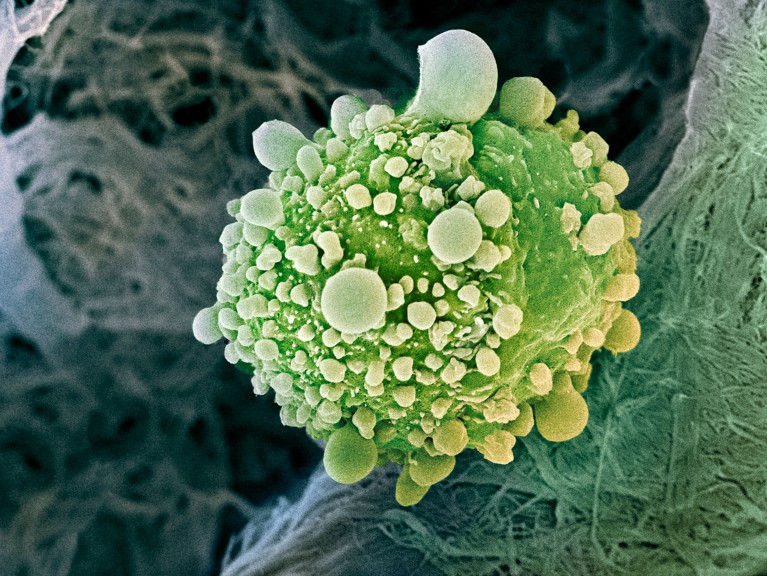 A coloured scanning electron micrograph of a spheroid pancreatic cancer cell covered in nodules