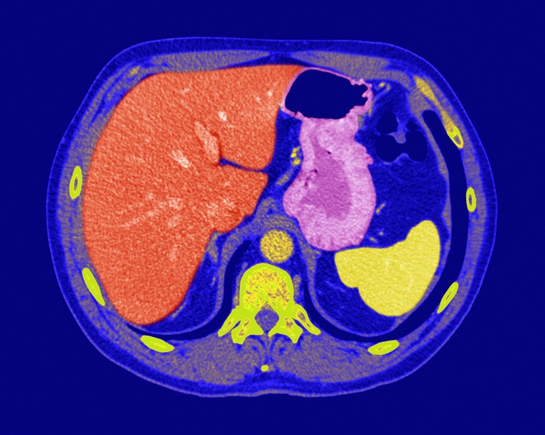 A CT scan of an axial section of a person's abdomen, showing the healthy liver (red), stomach (pink), and spleen (yellow).