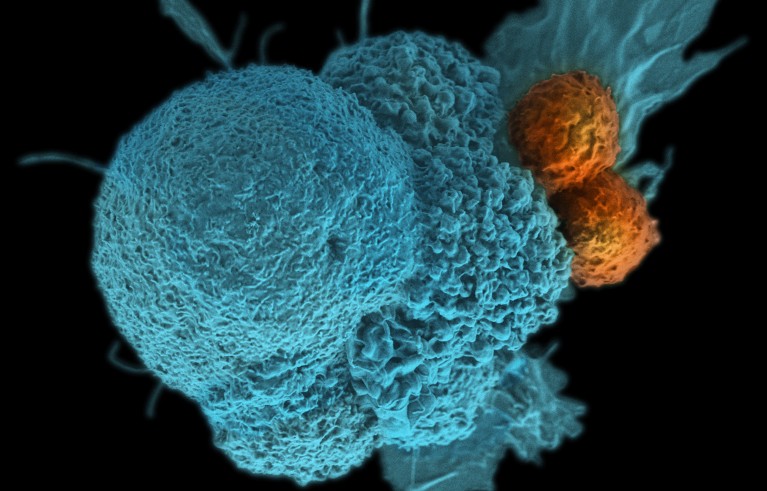 Coloured scanning electron micrograph of oral squamous cancer cell being attacked by two cytotoxic T cells.
