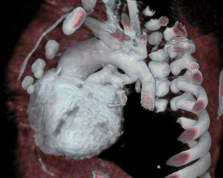 Congenital heart malformation, 3D CT scan.