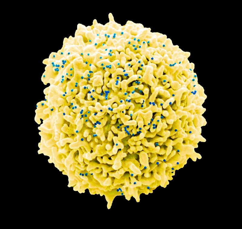 T cell infected with HIV. Color scanning electron micrograph (SEM)