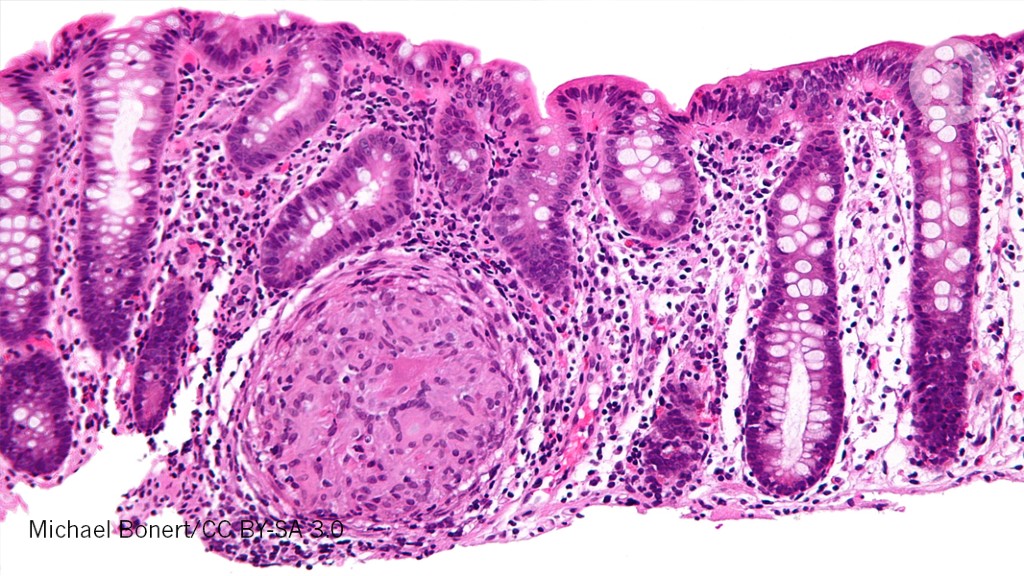 One gene links two different diseases : Research Highlights