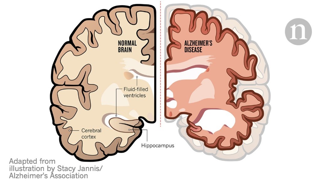 what-s-the-difference-between-ageing-and-dementia-queensland-brain