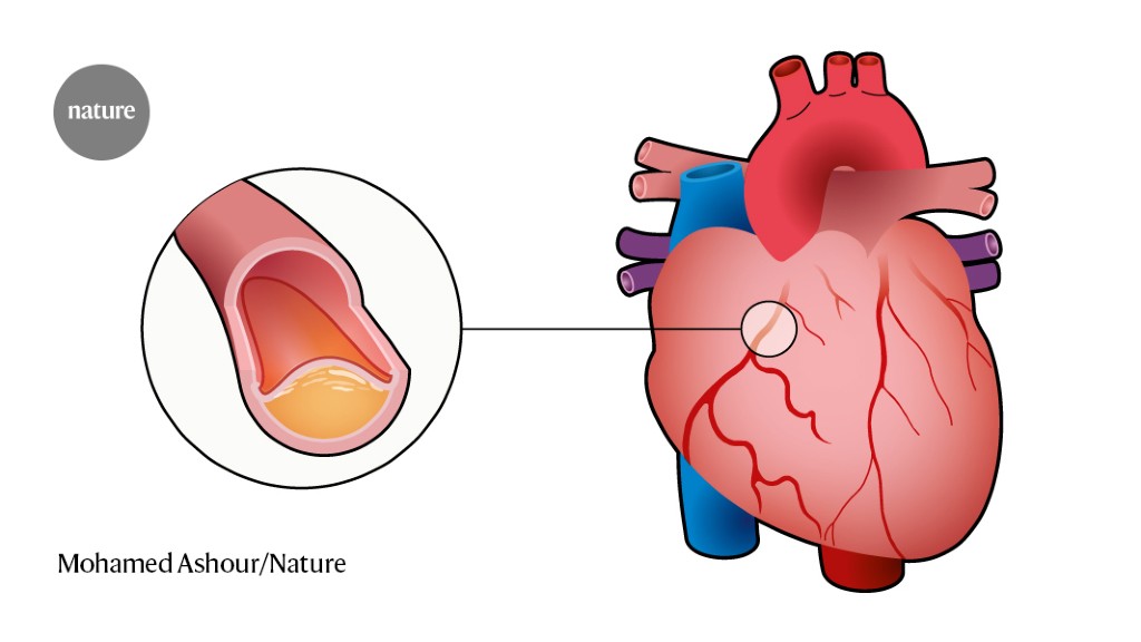 a-graphical-guide-to-ischaemic-heart-disease