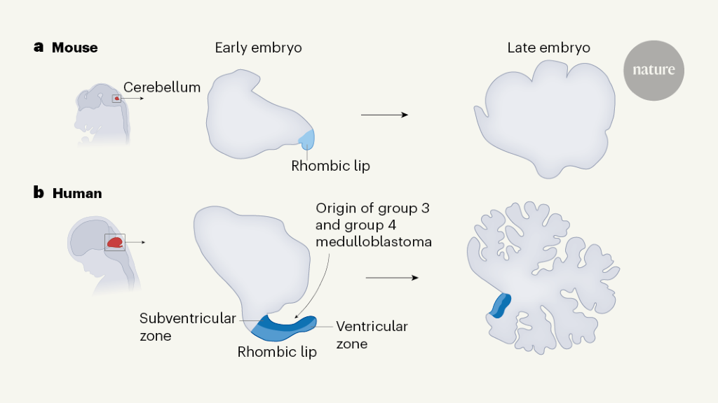 The origins of medulloblastoma tumours in humans