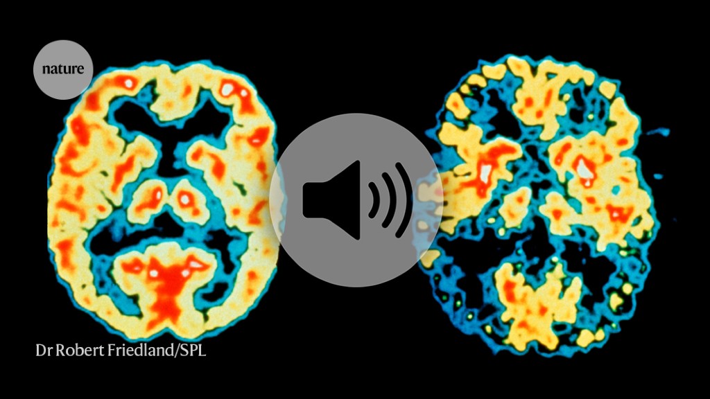 How a key Alzheimer’s gene wreaks havoc in the brain