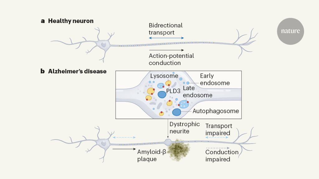 Swollen axons impair neuronal circuits in Alzheimer’s disease