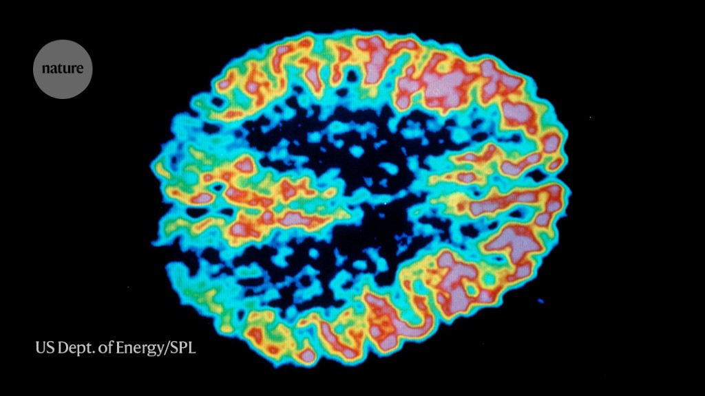 Heralded Alzheimer’s drug works — but safety concerns loom