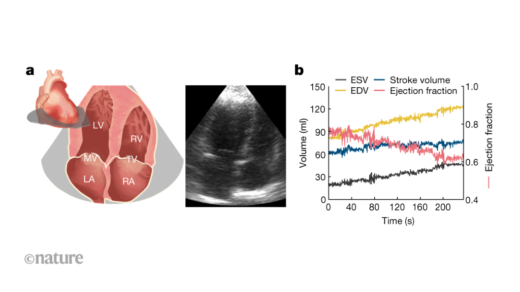 A wearable ultrasound patch for continuous heart imaging