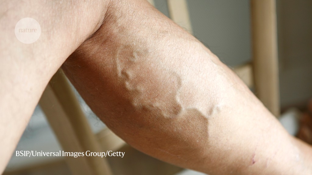 Huge genomic study shows varicose veins’ links to height and weight