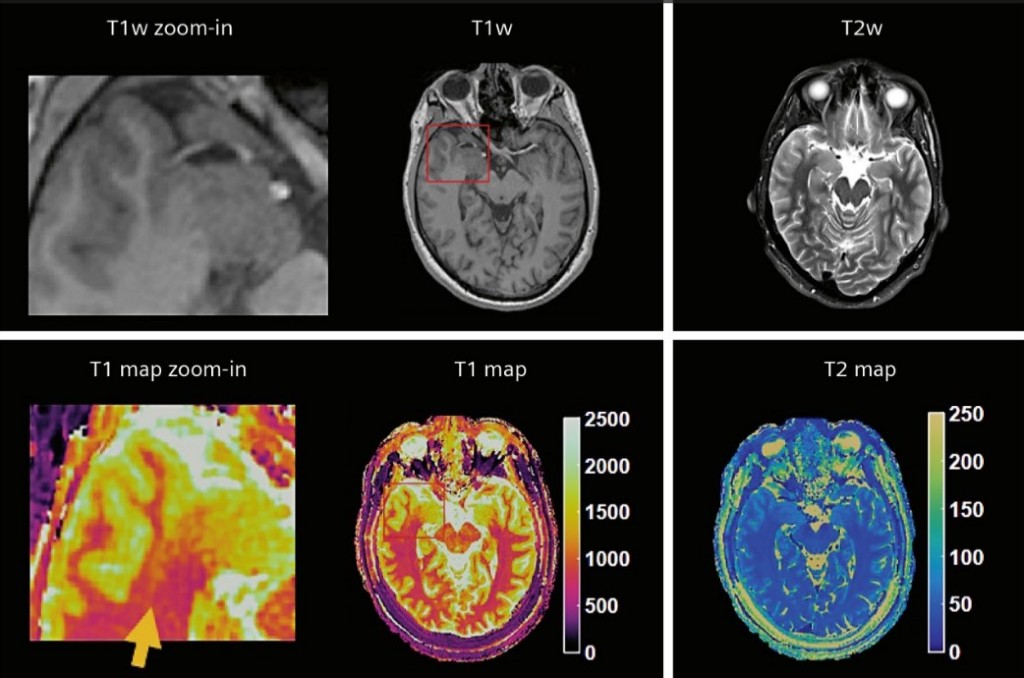 Diagnostic detectives: Magnetic Resonance Fingerprinting to help