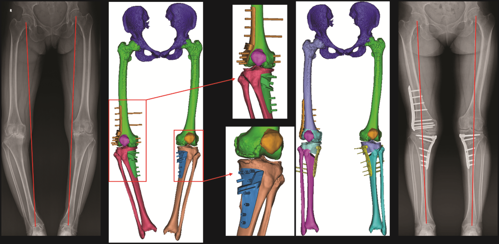 Improving bone and muscle health in an ageing population