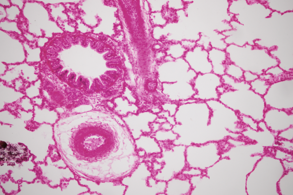 Improving survival rates with high-tech lung cancer detection and treatment