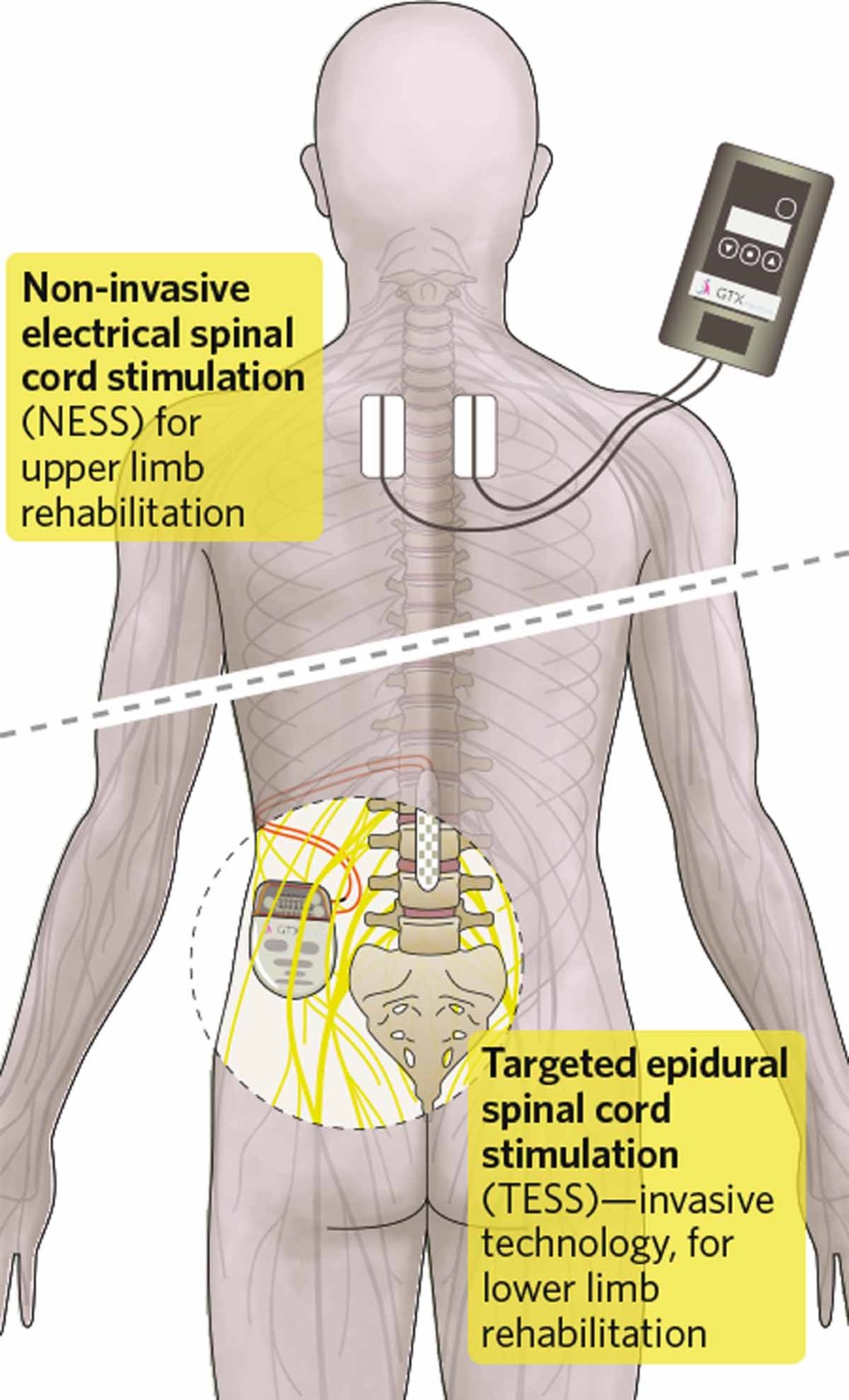 Spinal cord stimulation