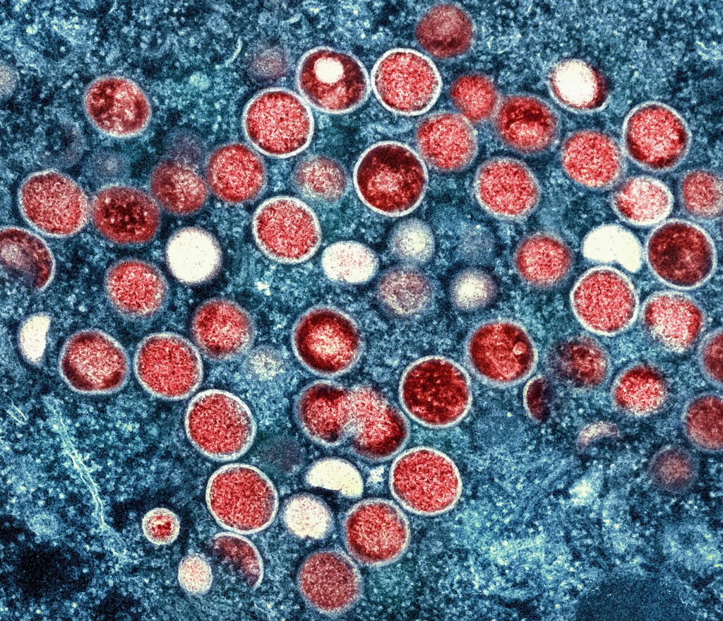 Mpox Virus Evolving Due To Sustained Human Transmission