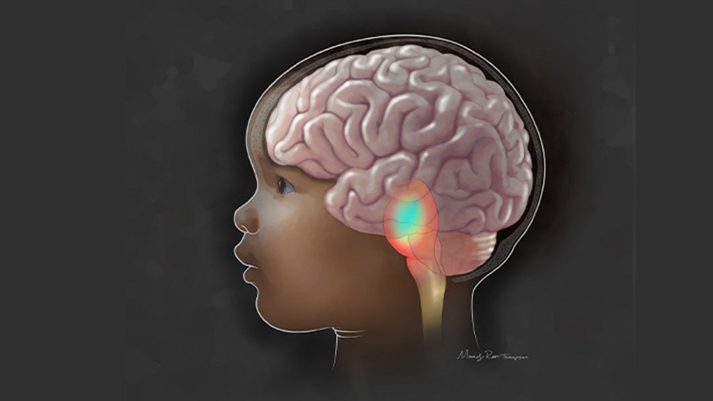 Expediting precision medicine for pediatric brain cancers