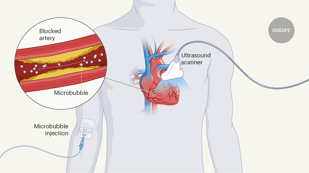 Microbubble ultrasound maps hidden signs of heart disease