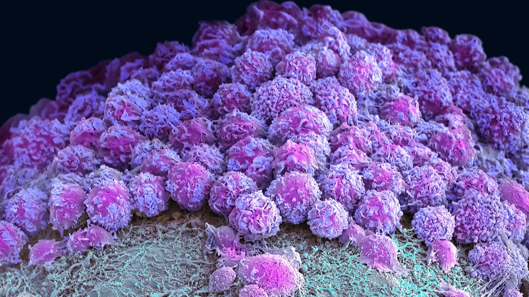 Mini-colon and brain ‘organoids’ shed light on cancer and other diseases