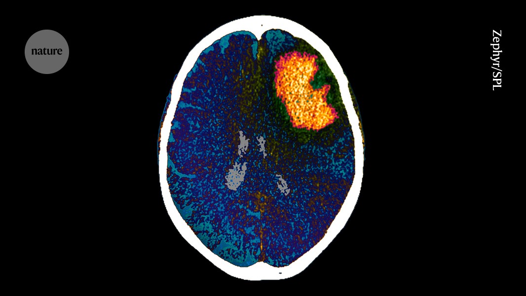 Who’s likely to wake up from a coma? Brain waves provide a clue