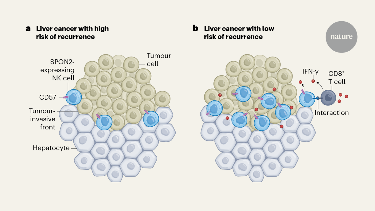 Liver cancer recurrence predicted by immune-cell location and gene ...