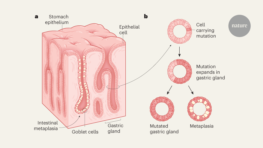 Mutations that accrue through life set the stage for stomach cancer