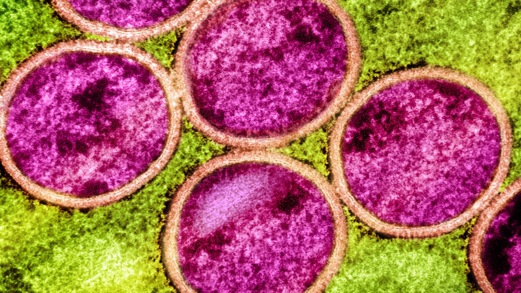 A front-line antiviral drug disappoints against worrisome monkeypox strain